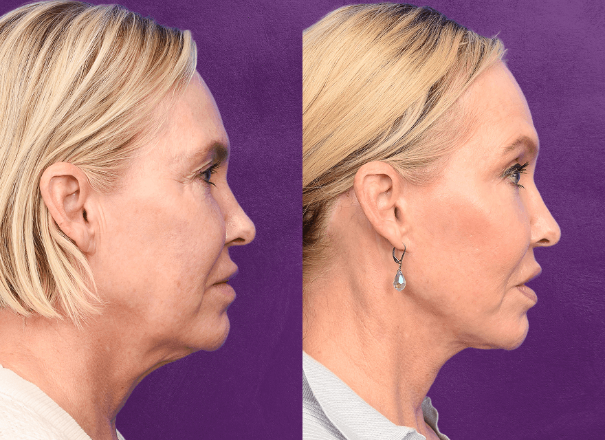 Before and after facial profile transformation.