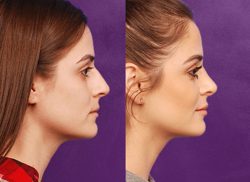 Before and after facial profile comparison.