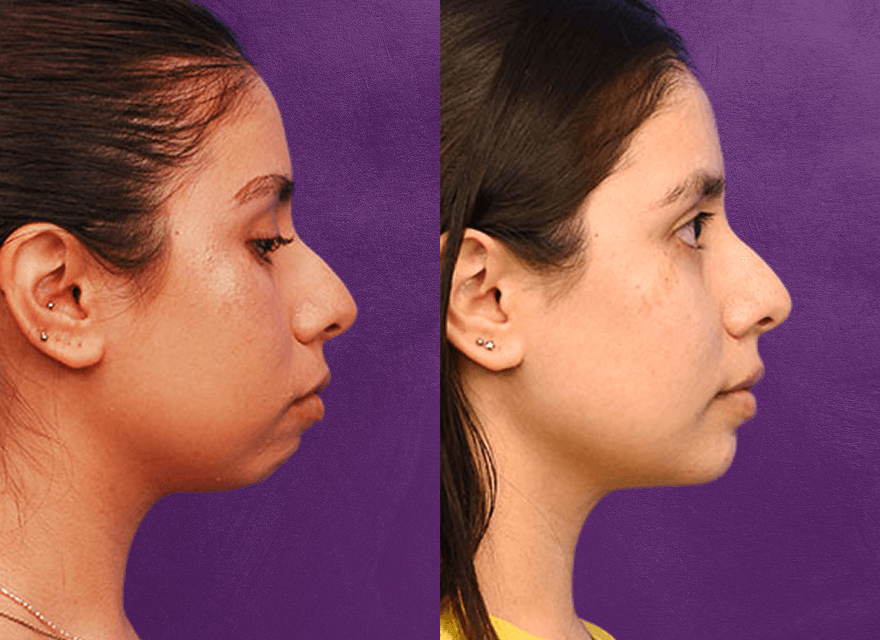 Profile comparison before and after treatment.