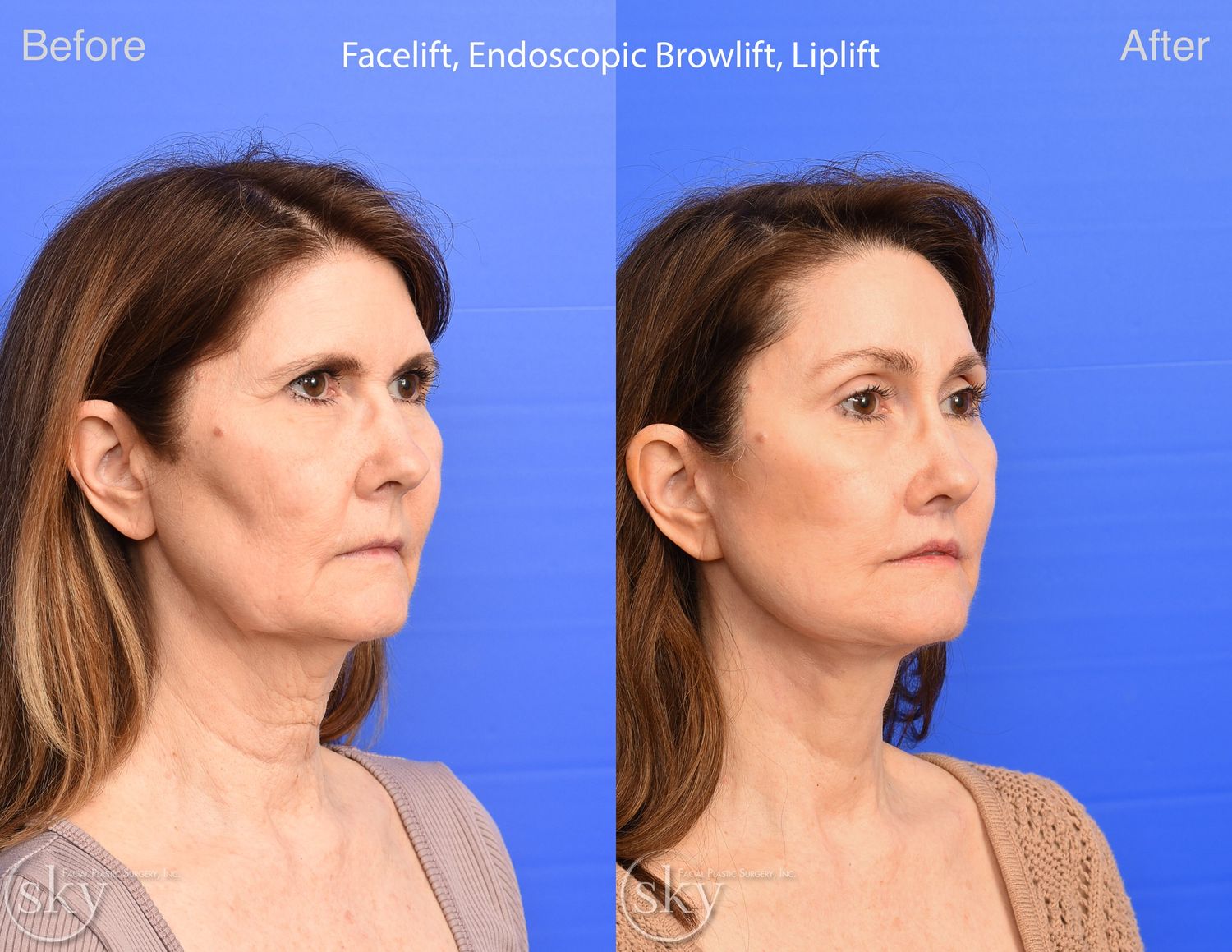 Brow Lift Before & After