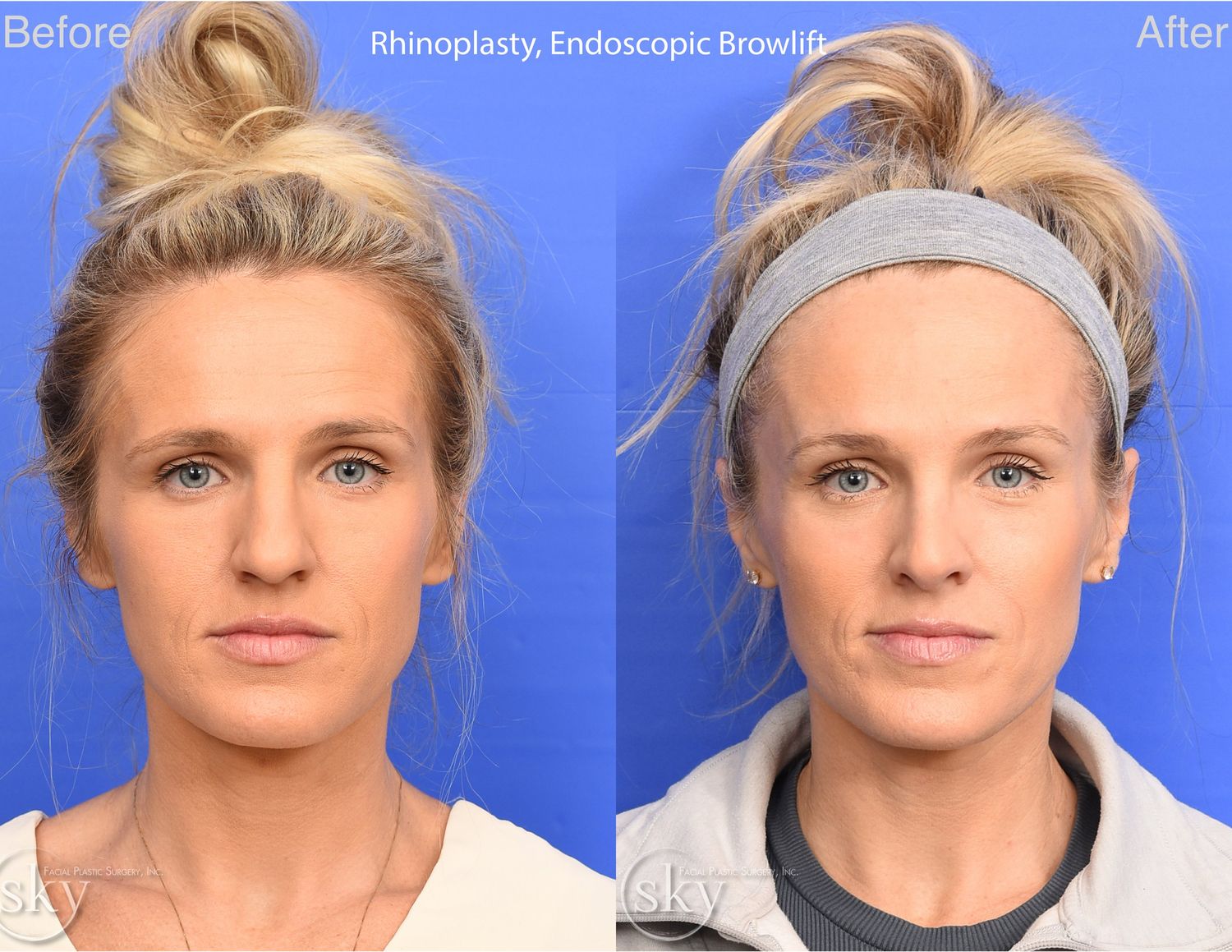 Brow Lift Before & After