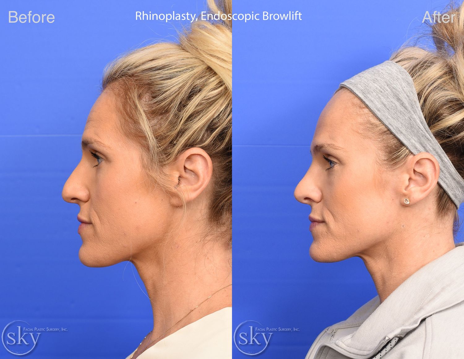 Brow Lift Before & After