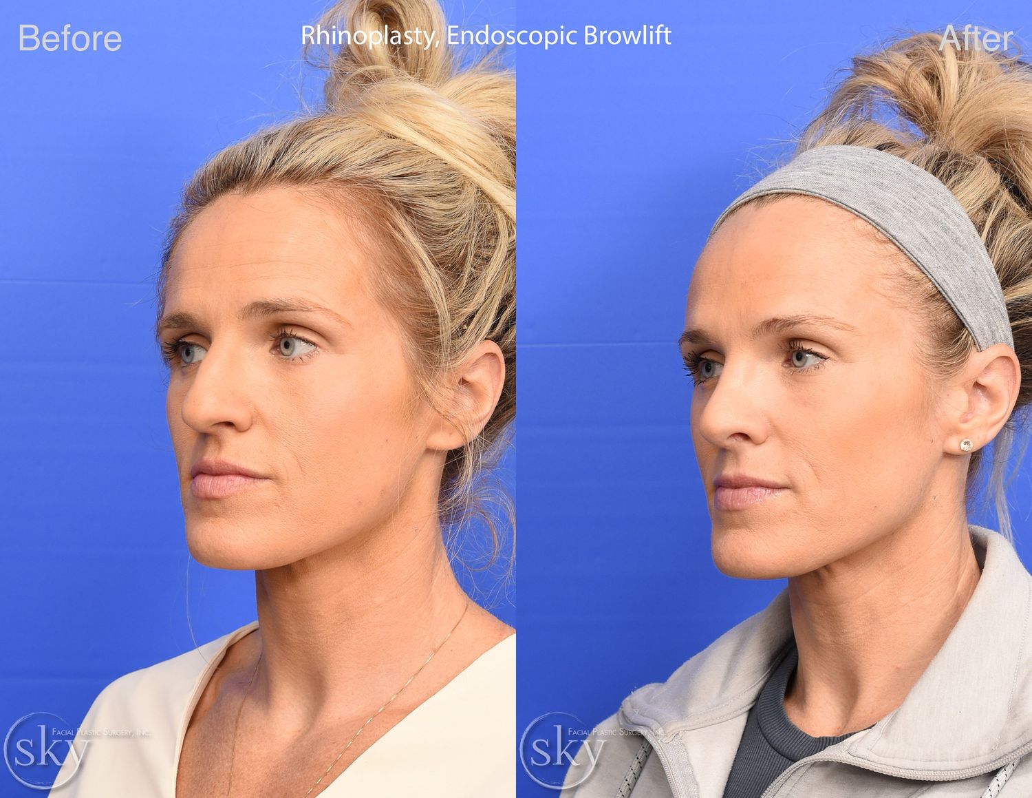 Brow Lift Before & After