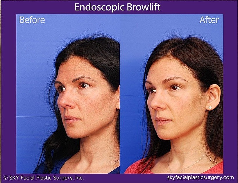 Brow Lift Before & After