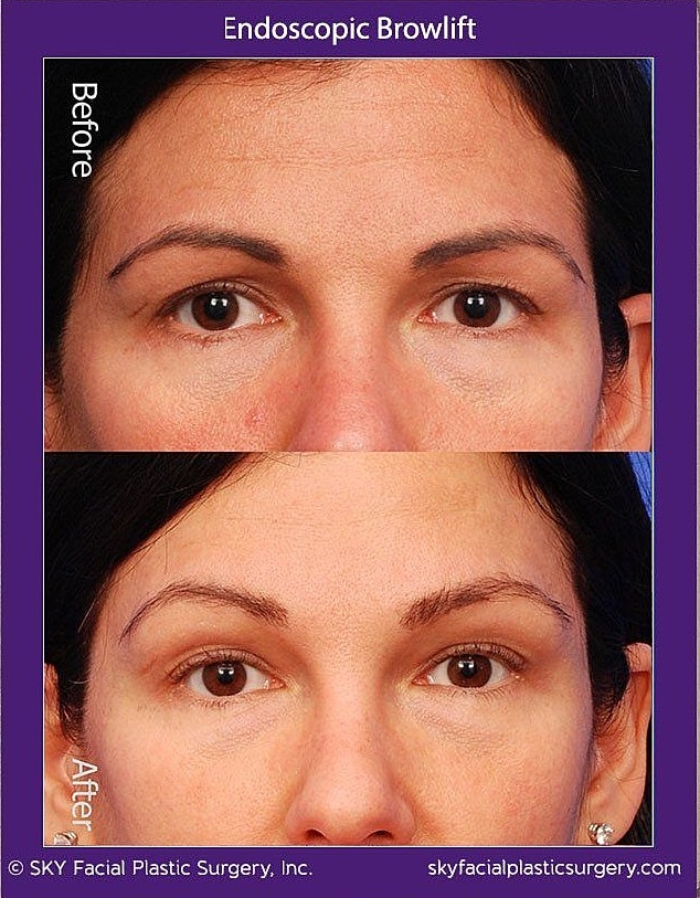 Brow Lift Before & After