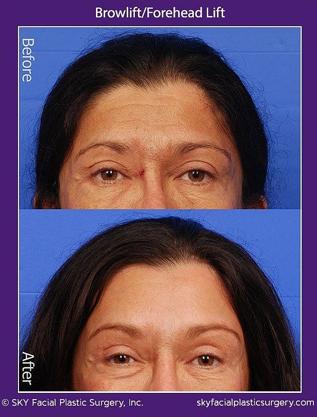 Brow Lift Before & After