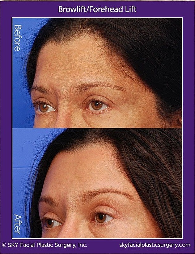 Brow Lift Before & After