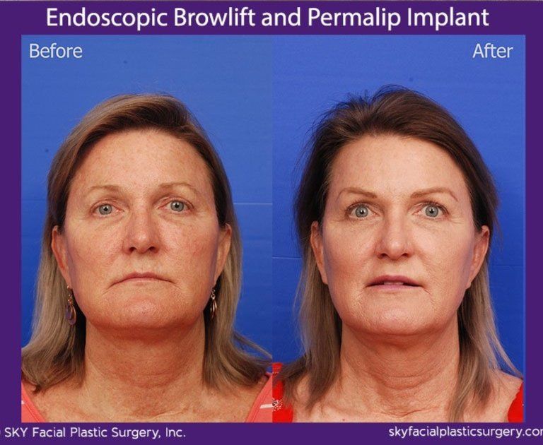 Brow Lift Before & After