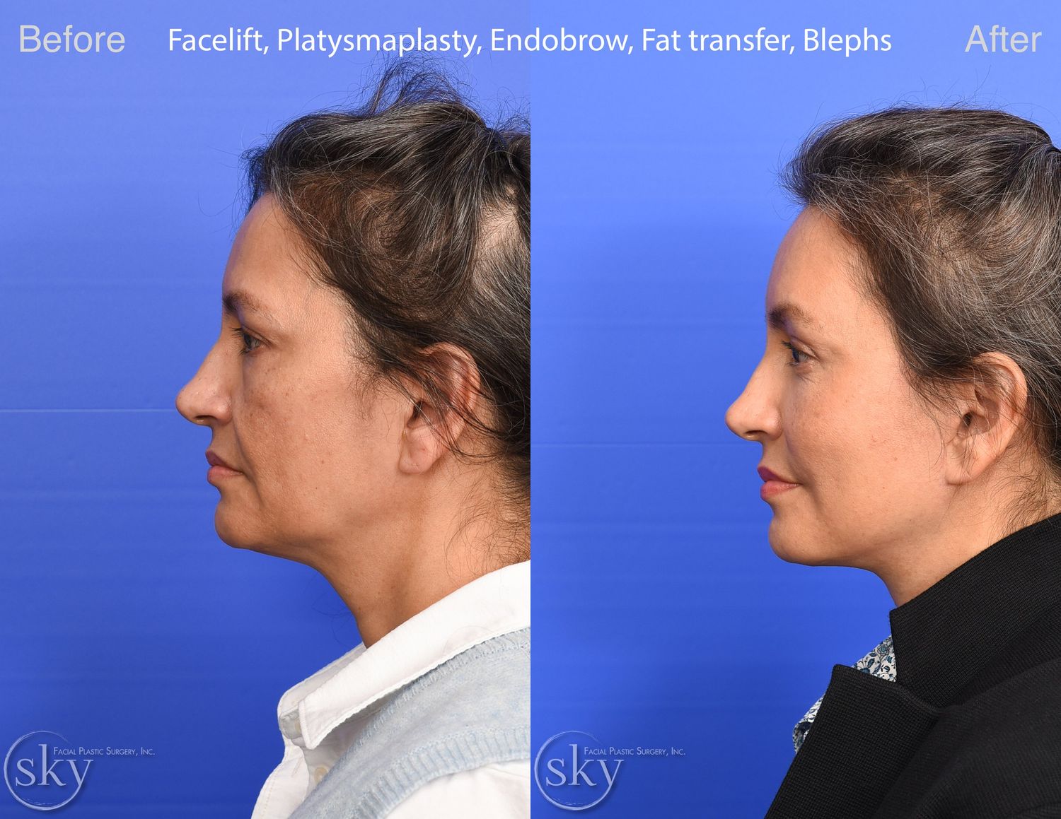 Brow Lift Before & After