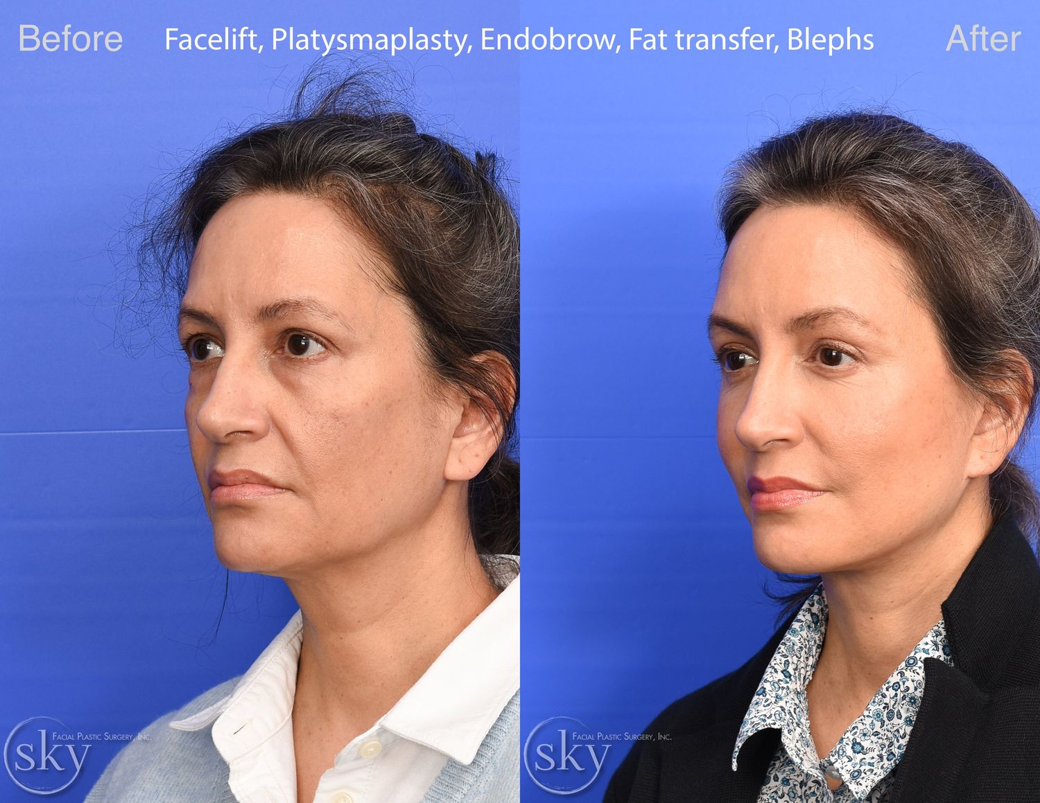 Brow Lift Before & After