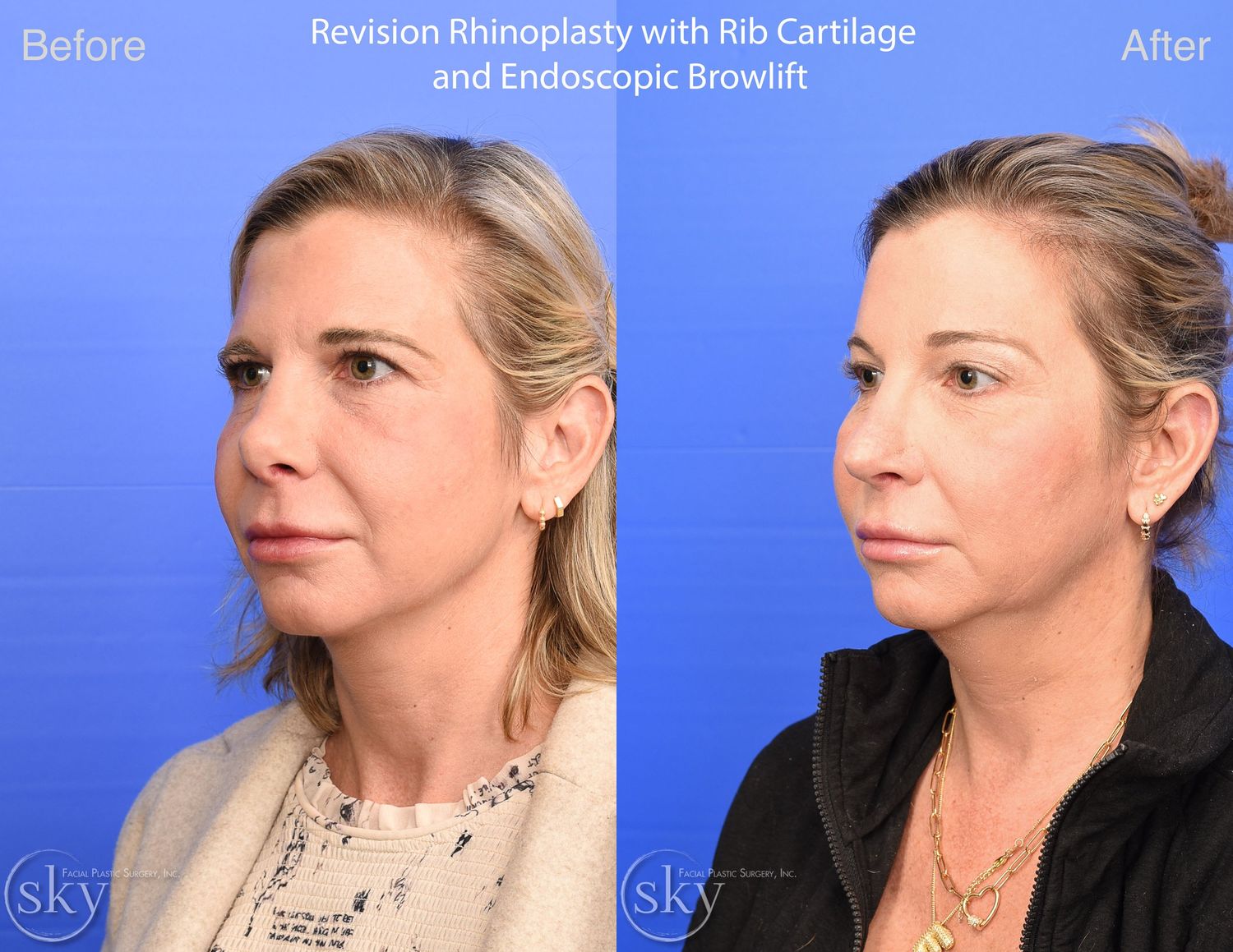 Brow Lift Before & After