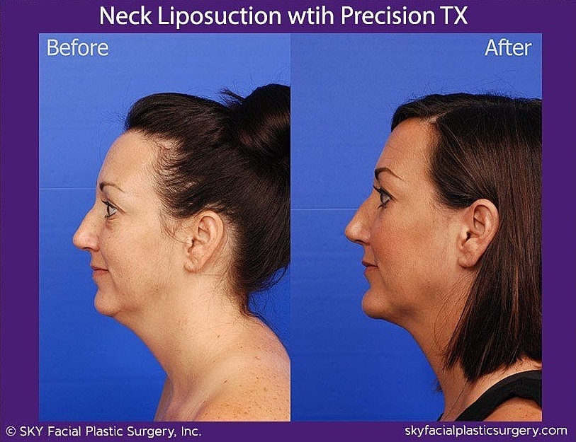 Neck Liposuction Before & After