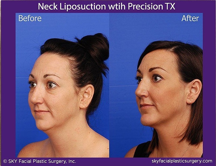 Neck Liposuction Before & After