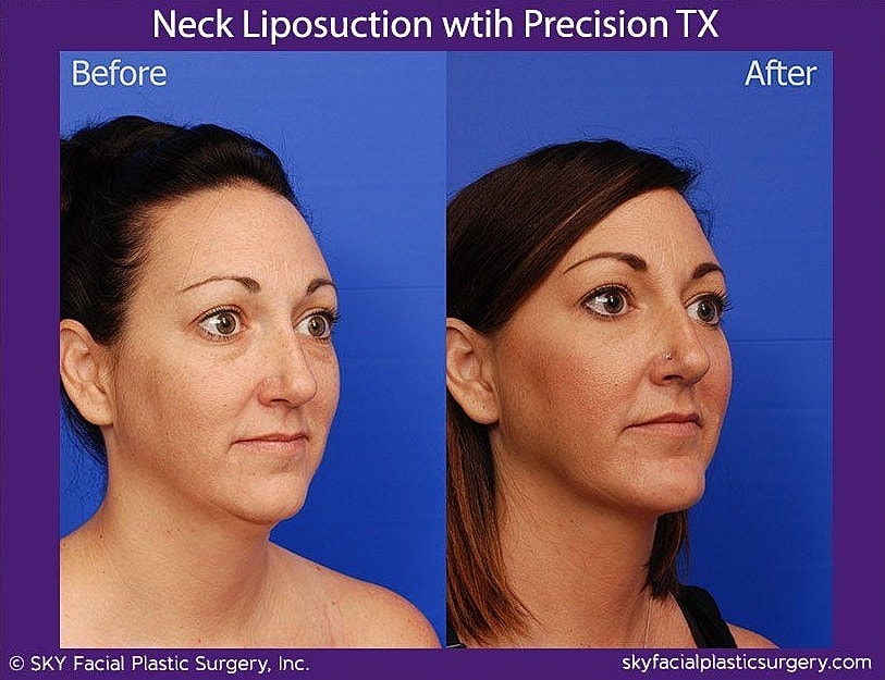 Neck Liposuction Before & After