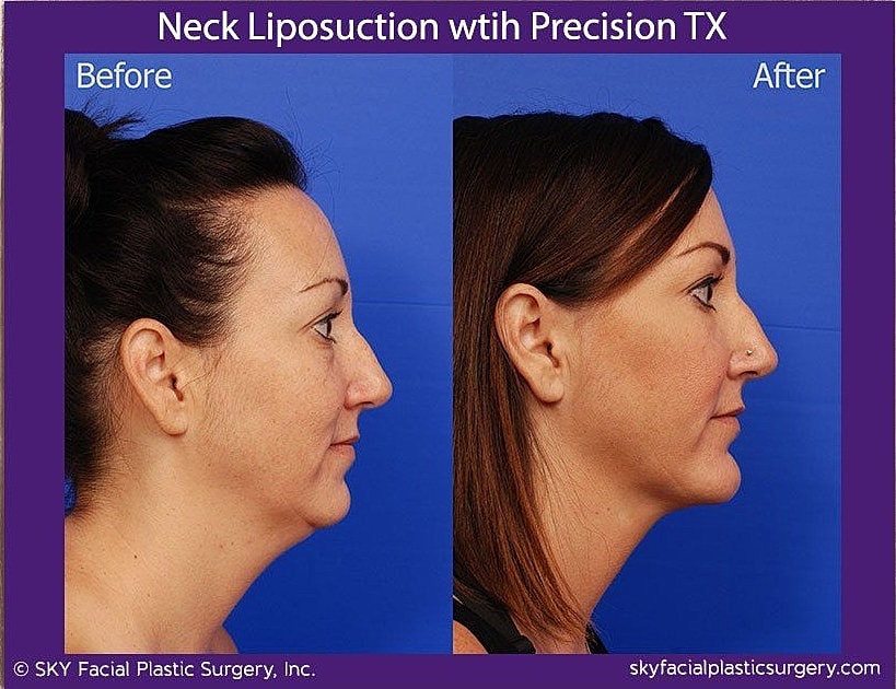 Neck Liposuction Before & After