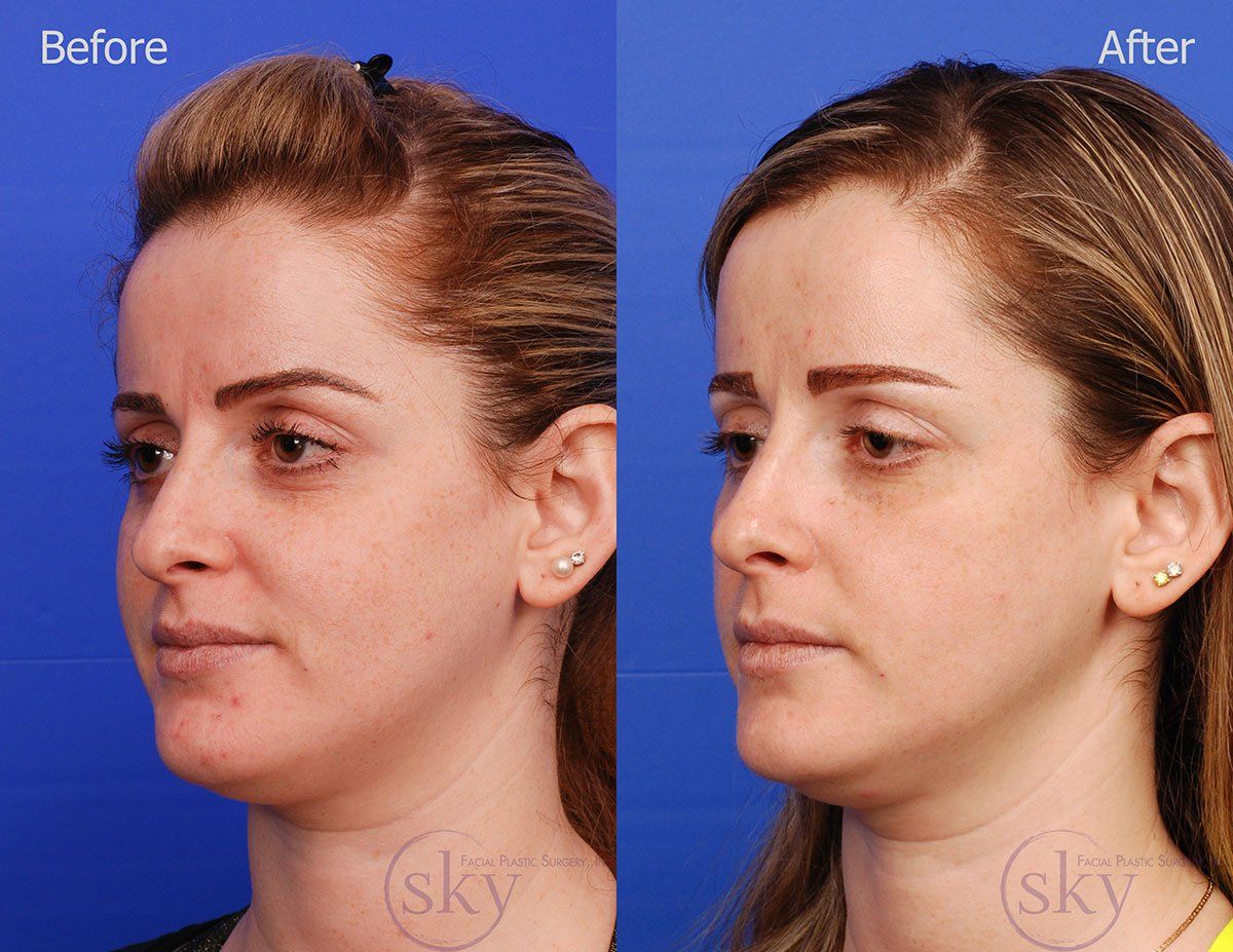 Pearl Fractional Before & After