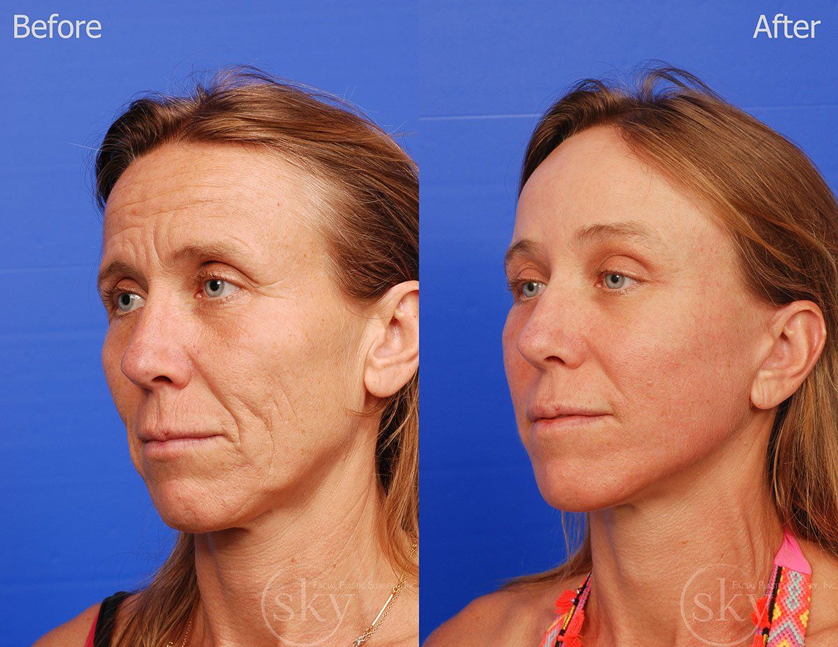 Pearl Fractional Before & After