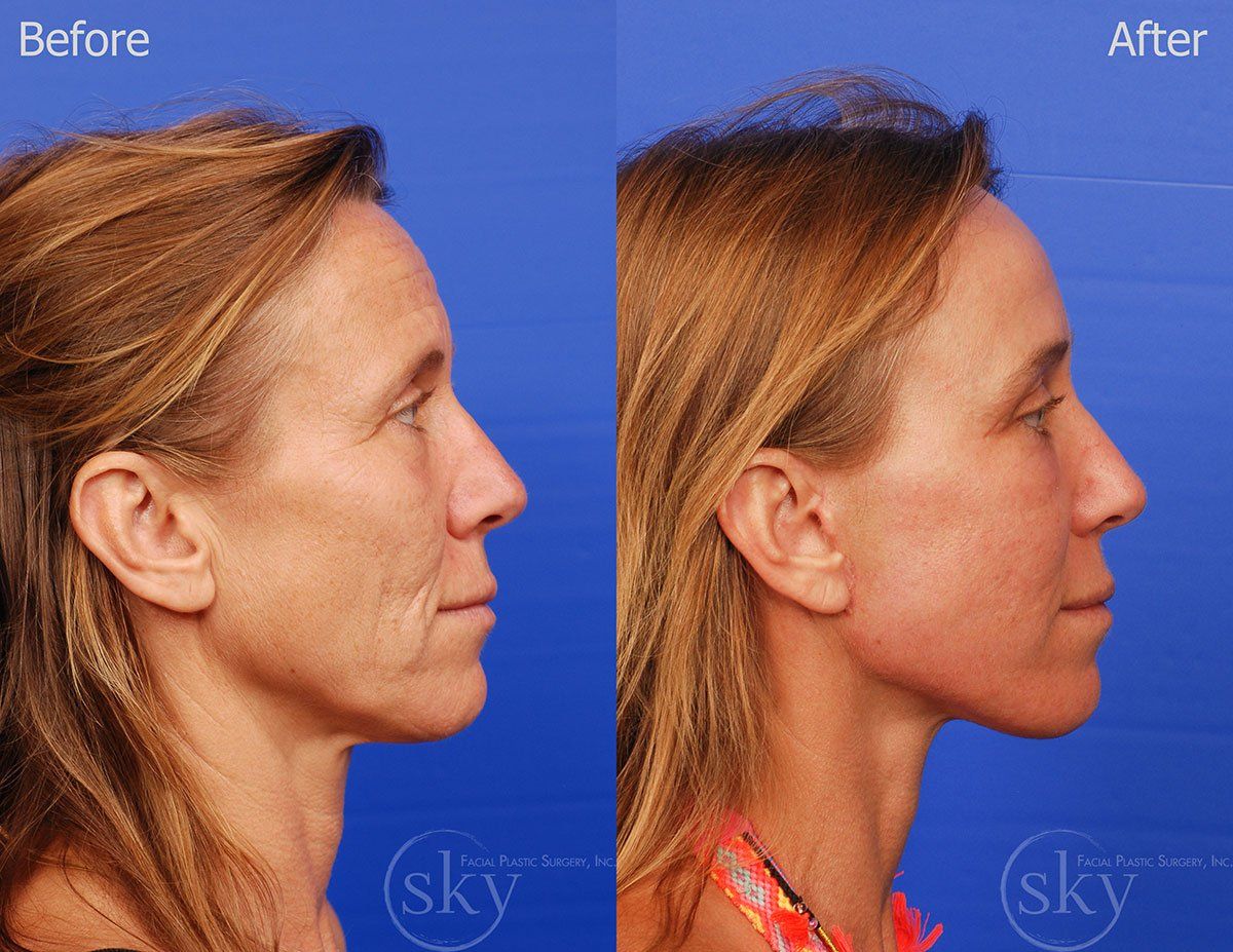 Pearl Fractional Before & After