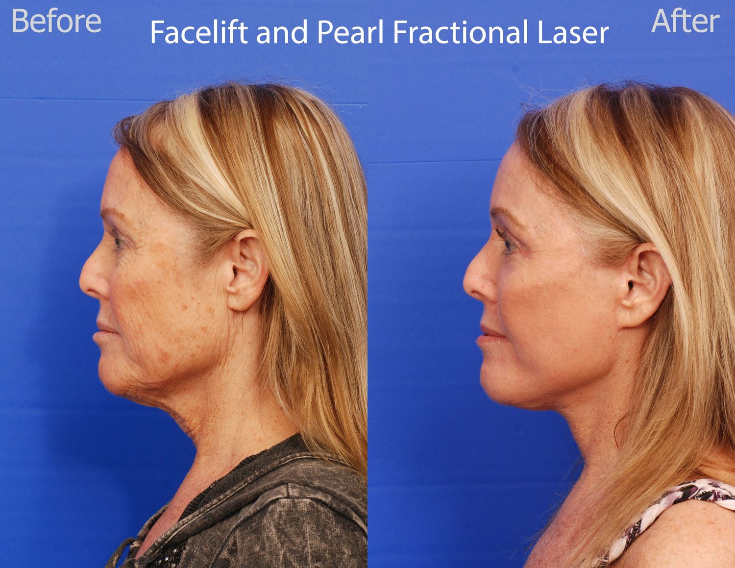 Pearl Fractional Before & After