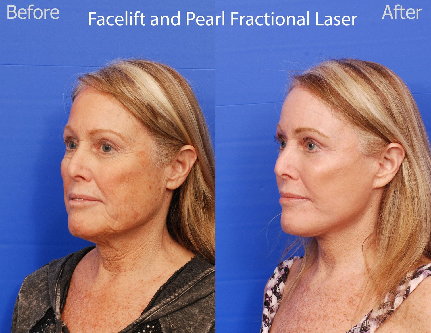 Pearl Fractional Before & After