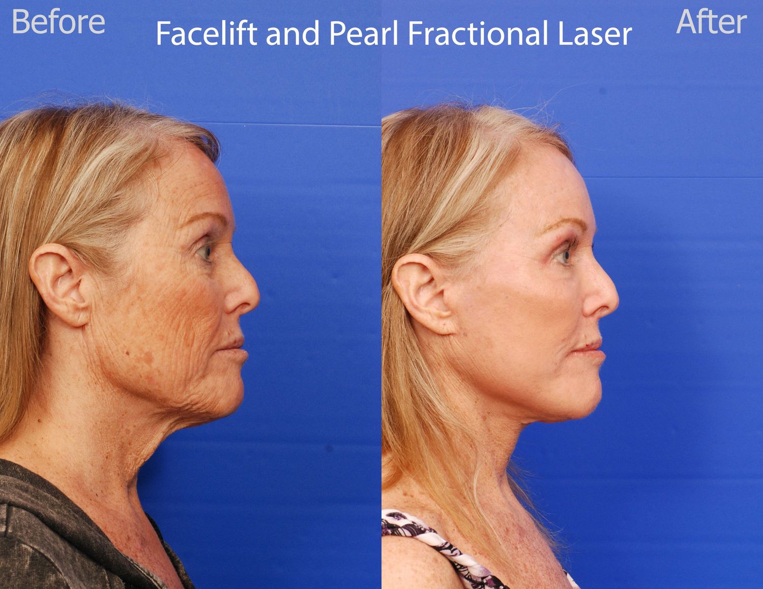 Pearl Fractional Before & After