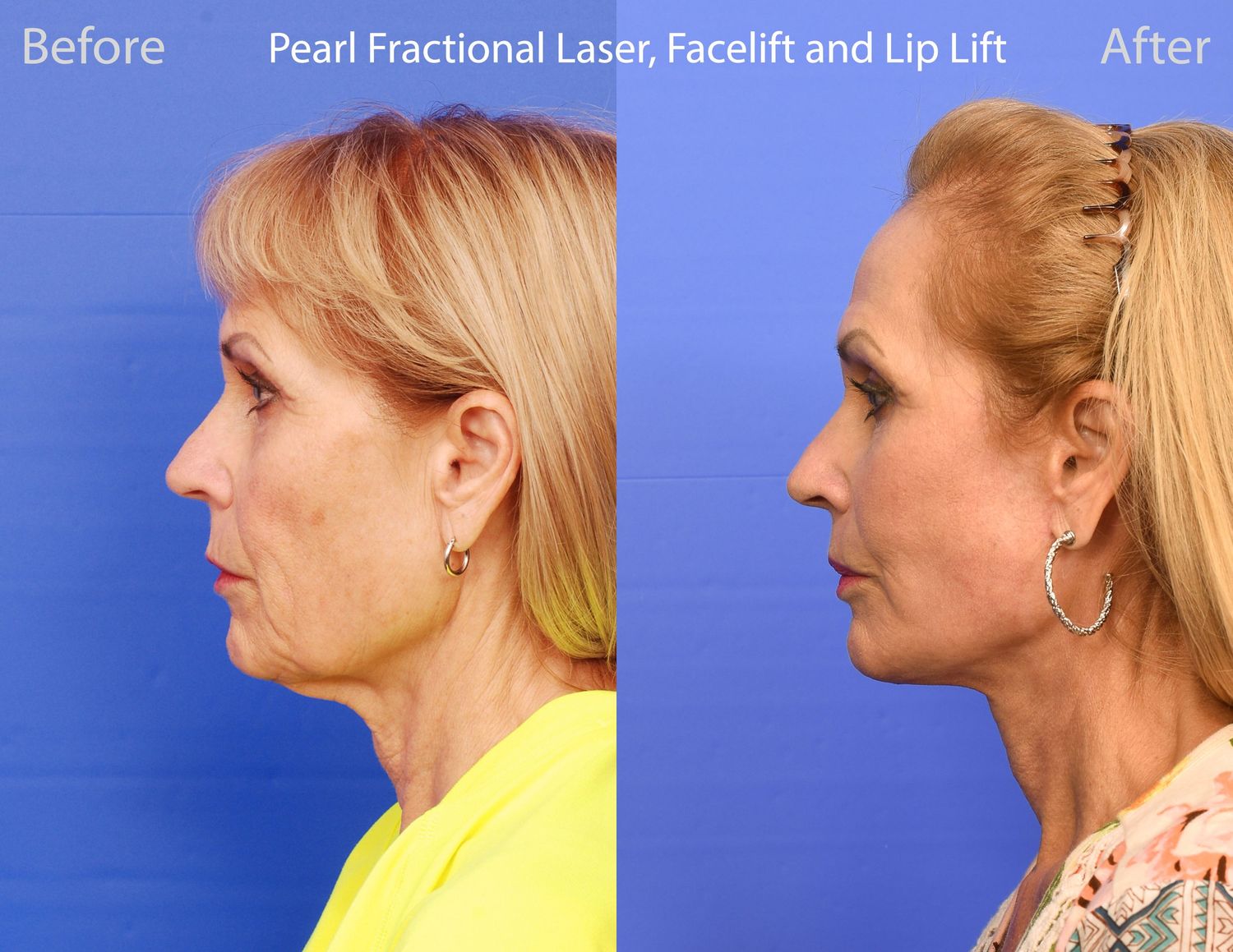 Pearl Fractional Before & After