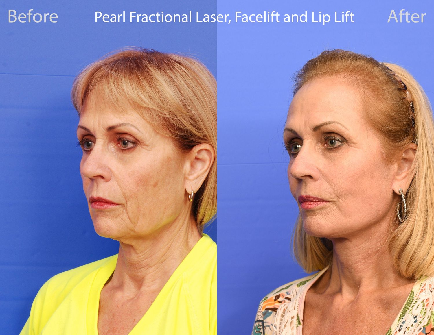Pearl Fractional Before & After