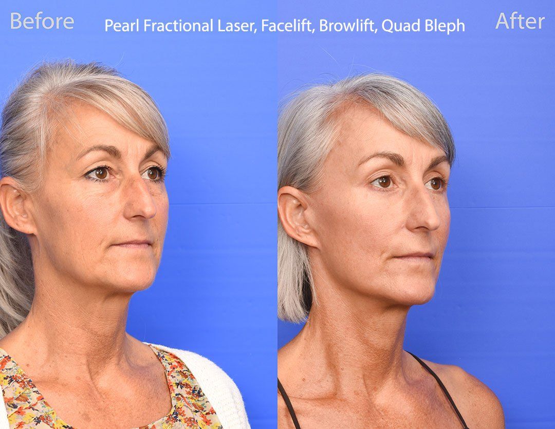 Pearl Fractional Before & After