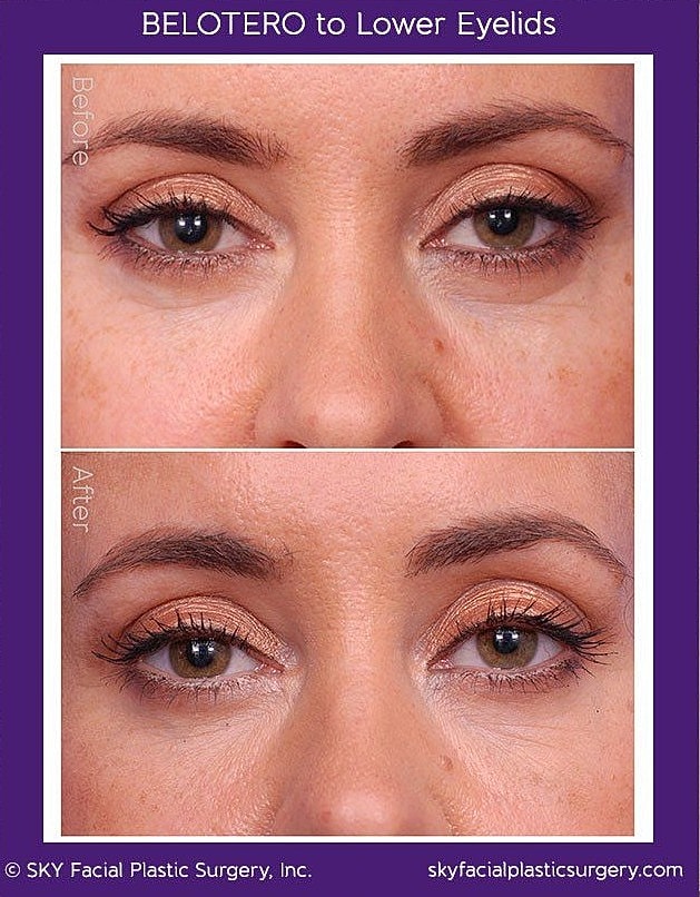 Belotera Tear Troughs Before & After