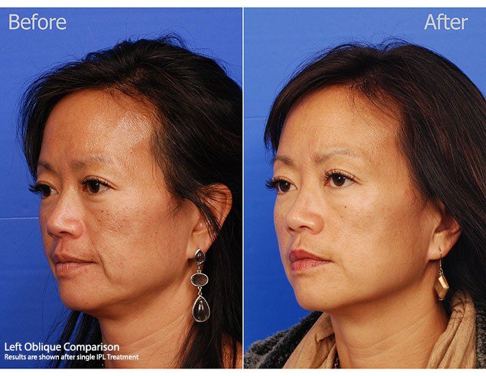 Ipl Laser Before & After