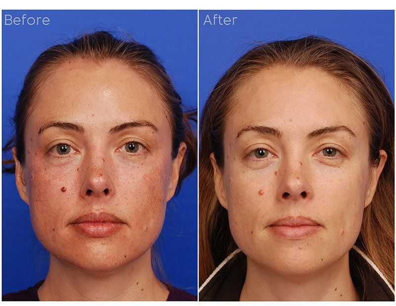 Ipl Laser Before & After