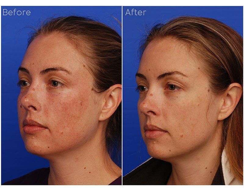 Ipl Laser Before & After