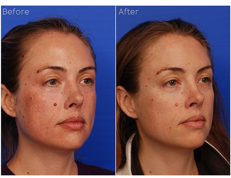 Ipl Laser Before & After