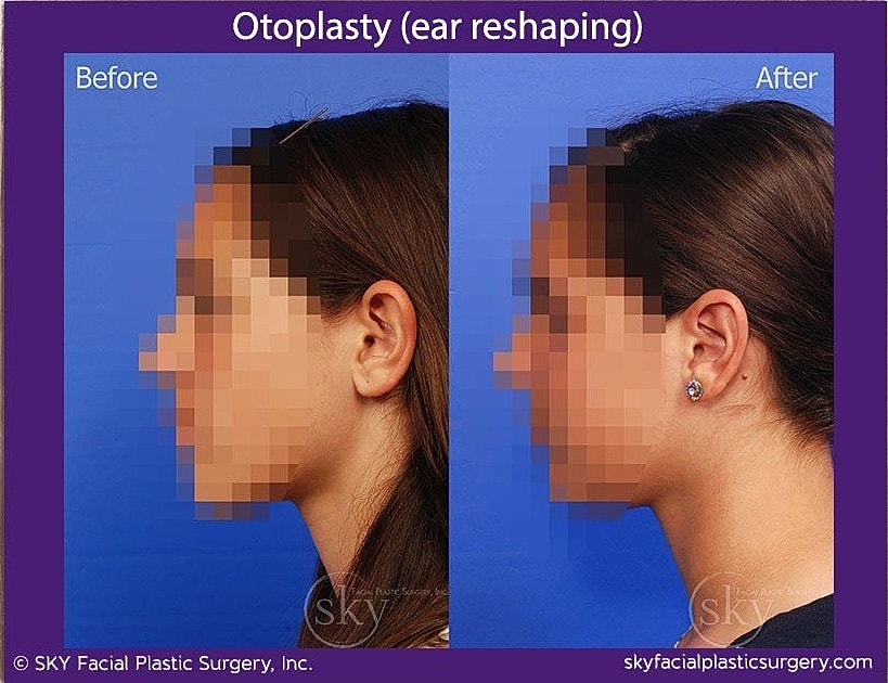 Otoplasty Before & After