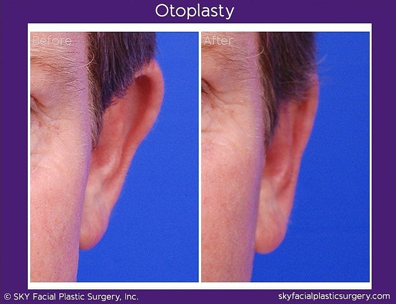 Otoplasty Before & After