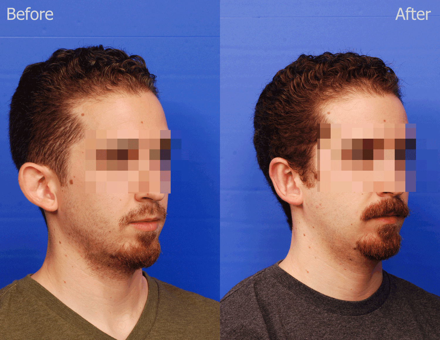 Otoplasty Before & After