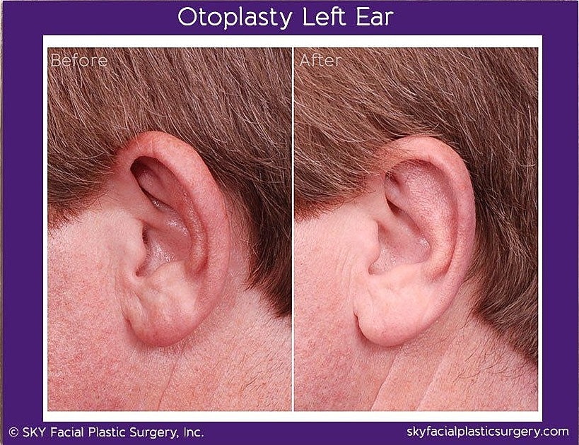 Otoplasty Before & After