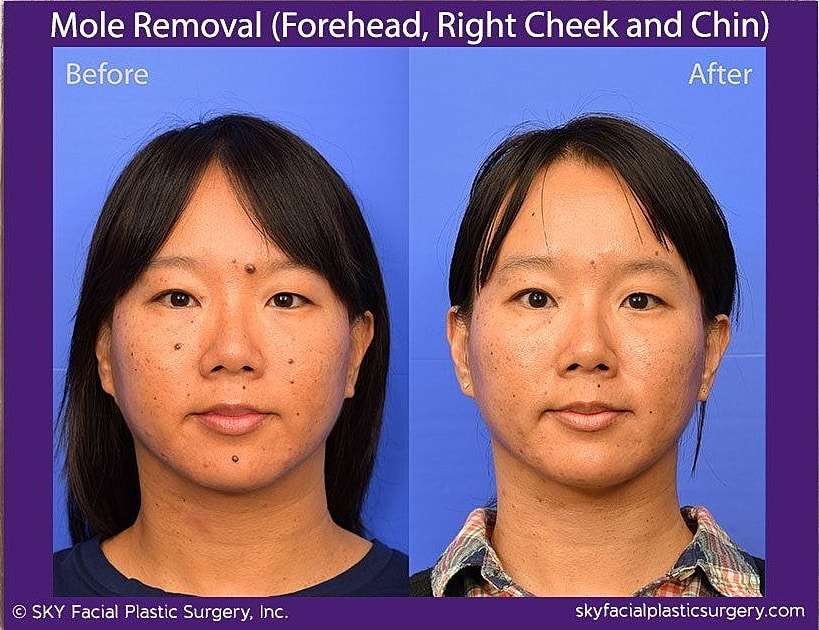 Mole Removal Before & After