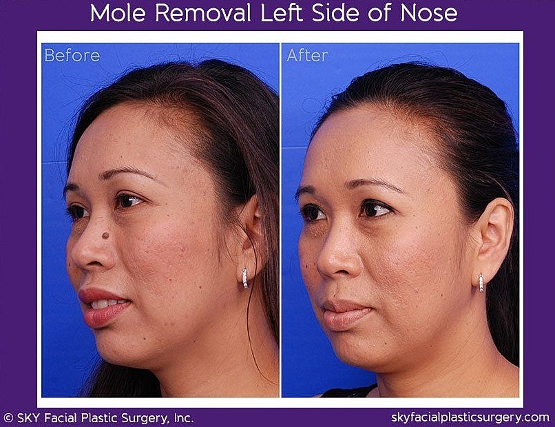 Mole Removal Before & After