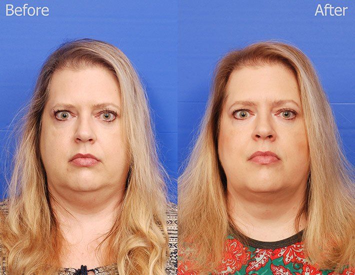 Kybella Before & After