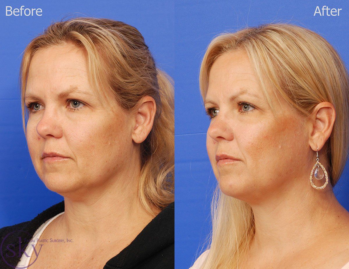 Kybella Before & After
