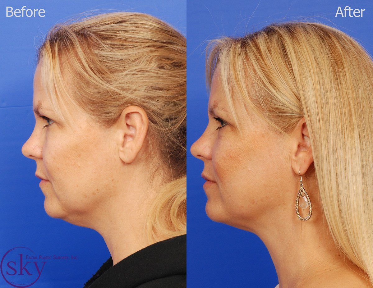 Kybella Before & After