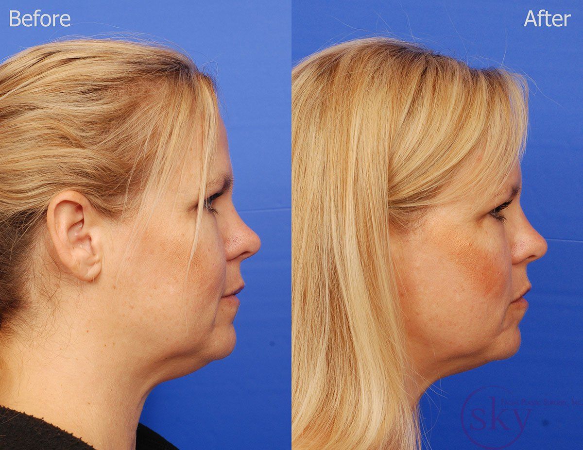 Kybella Before & After