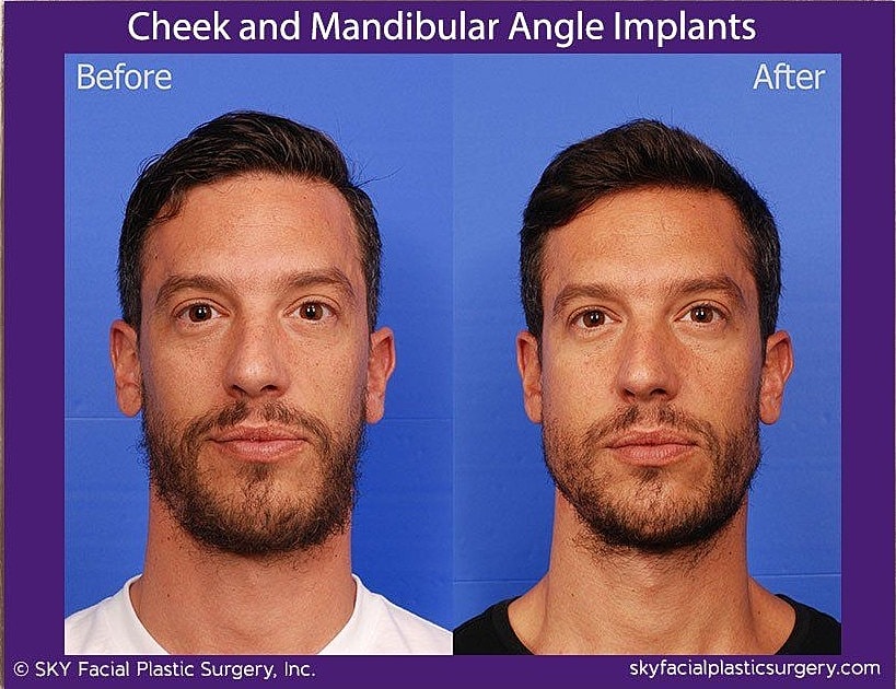 Jaw Contouring Before & After
