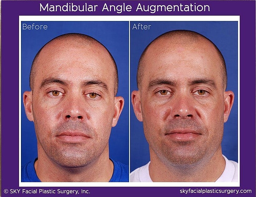 Jaw Contouring Before & After