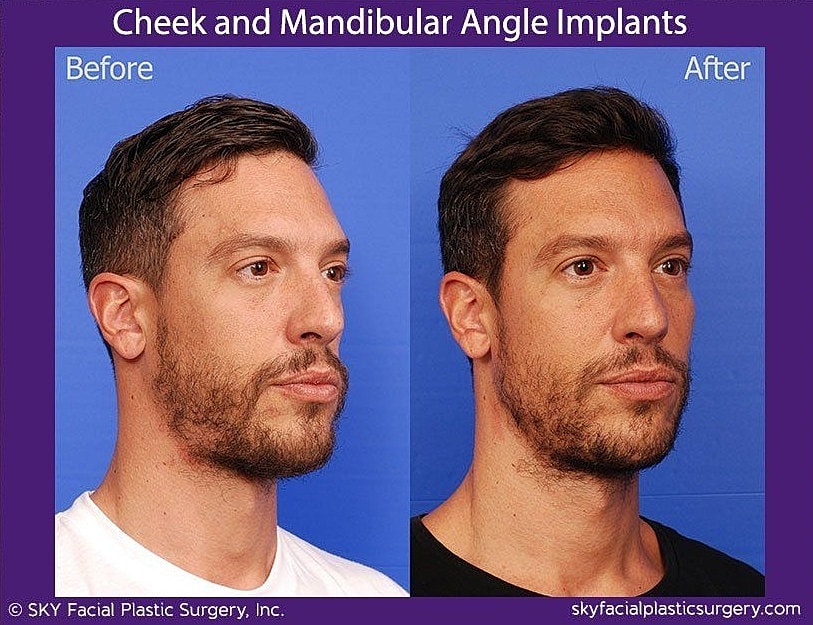 Jaw Contouring Before & After