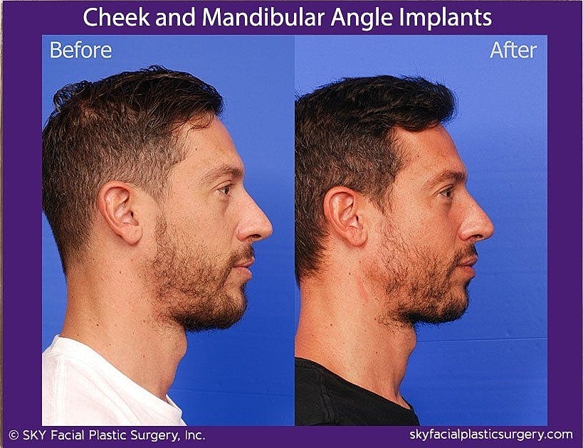 Jaw Contouring Before & After