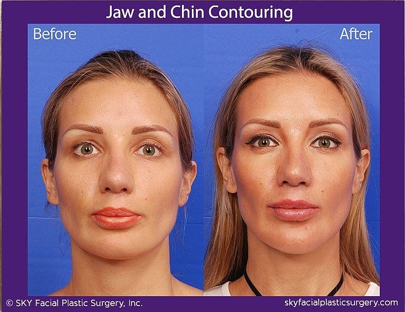 Jaw Contouring Before & After