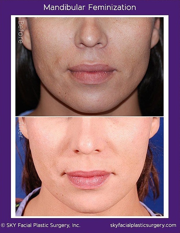 Jaw Contouring Before & After