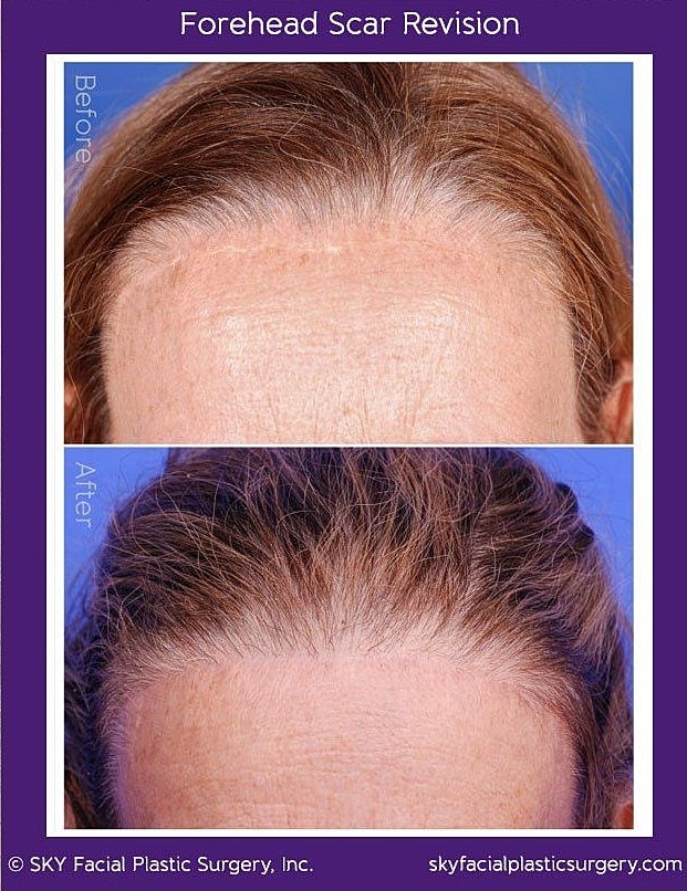 Scar Revision Before & After